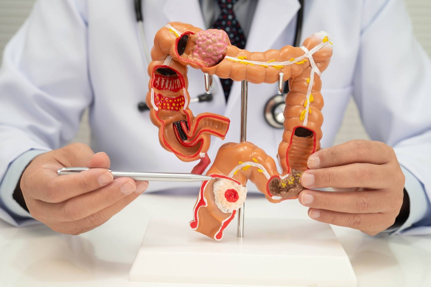 Colon Cancer Surgery