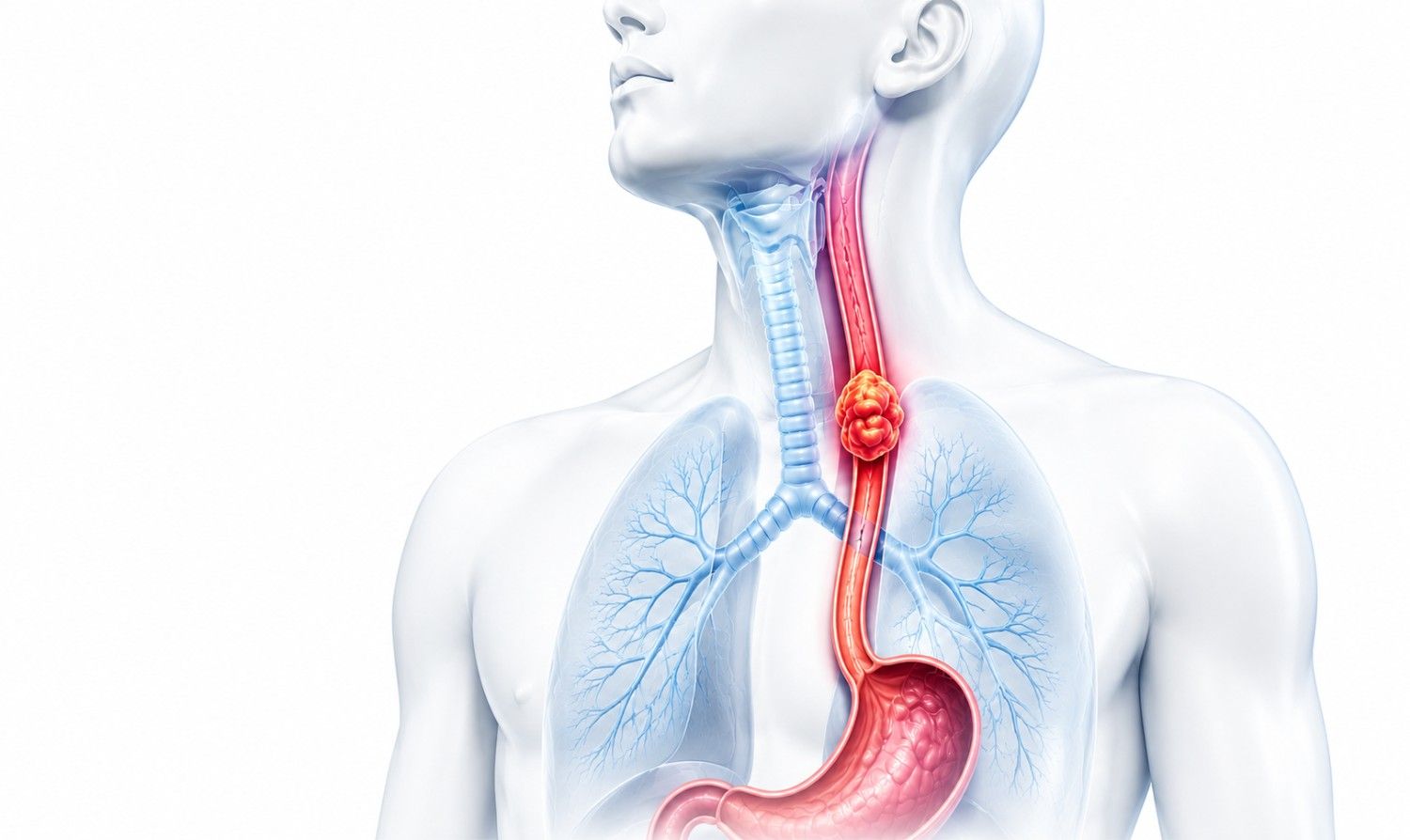 Esophagus Cancer Surgery-in-delhi