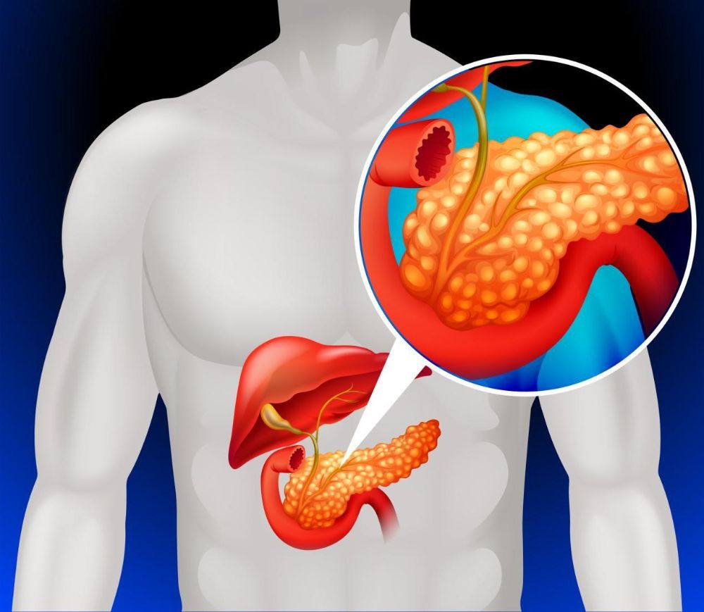 Pancreatic Cancer Surgery