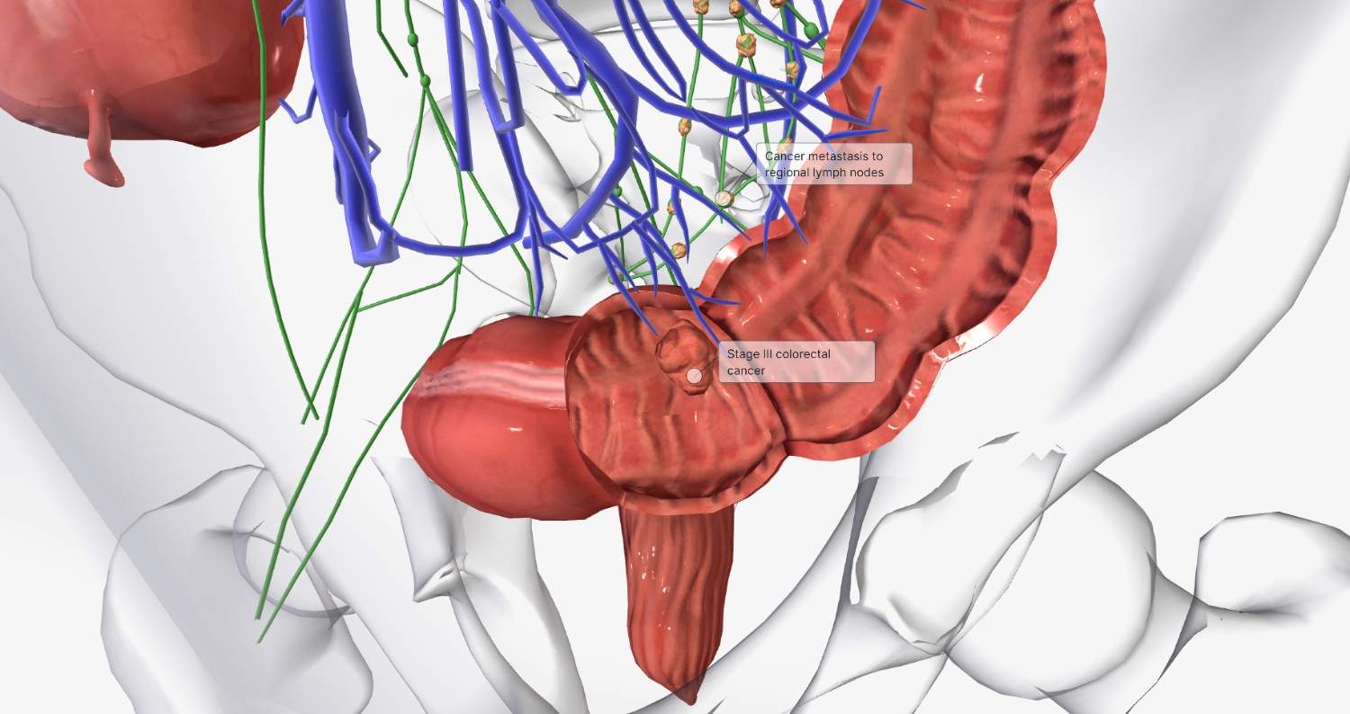 Rectum Cancer Surgeon
